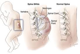 spina bifida.jpg