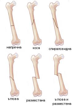 Фрактури-видове.jpg