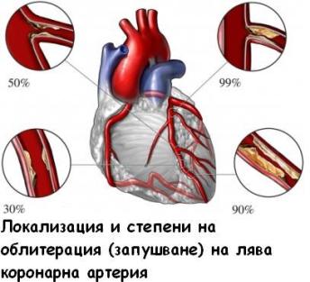 infarkt na miokarda1.JPG