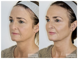 botox77.png