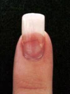 broken-nail.png broken-nail.png