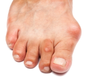 bunions.jpg