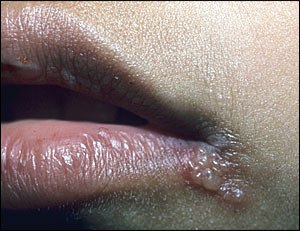 herpes.jpg