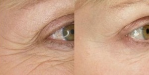 eye-wrinkles.jpg