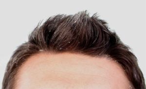dandruff.jpg