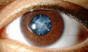 cataracta.jpg cataracta.jpg