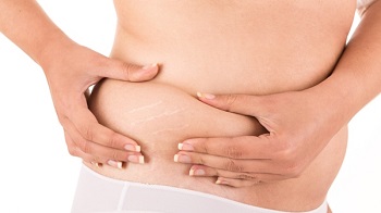 Erase-Stretch.jpg Erase-Stretch.jpg