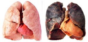 SmokersLungs.jpg SmokersLungs.jpg