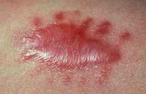 keloid.jpg