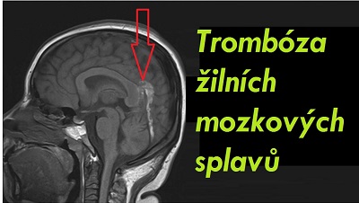 tromboza-mozkovych-zilnich-splavu-priznaky-projevy-symptomy.jpeg