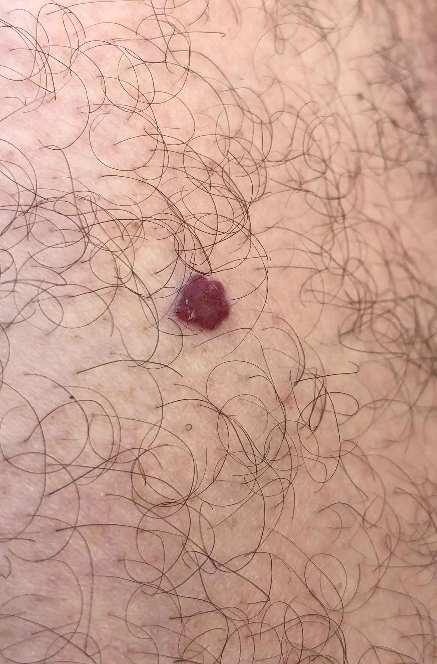 Първата снимка е от външната страна на бедрото, там е най-голямото топче / CDFDC0B5-6C35-404B-8F3A-EFD948E7DD4E.jpeg CDFDC0B5-6C35-404B-8F3A-EFD948E7DD4E.jpeg