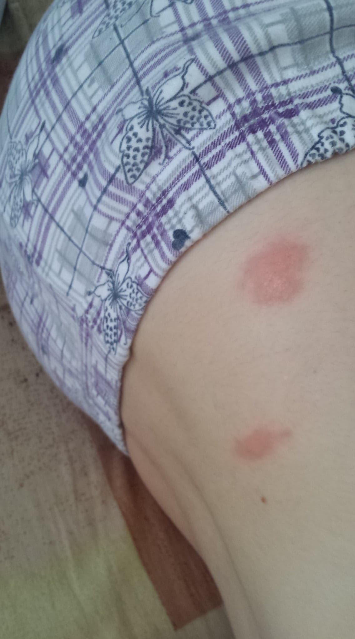 тези са на кръста ми и вече има само избледнели петна от тях / 38284495_1089170887887662_2023816799220400128_n.jpg 38284495_1089170887887662_2023816799220400128_n.jpg