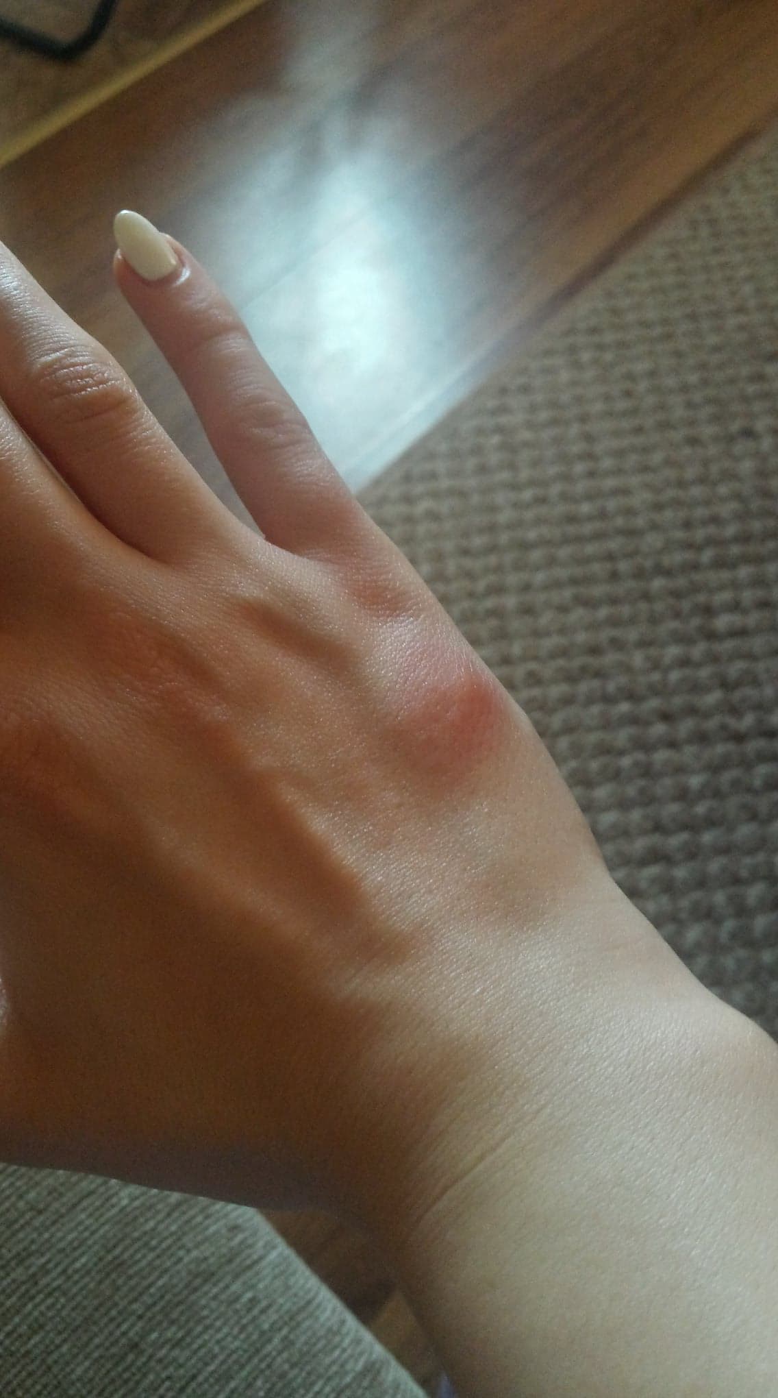 това отново е на ръката ми и държа да кажа че доста се подува при чесане / 38458545_1089171254554292_6175338475366121472_n.jpg 38458545_1089171254554292_6175338475366121472_n.jpg