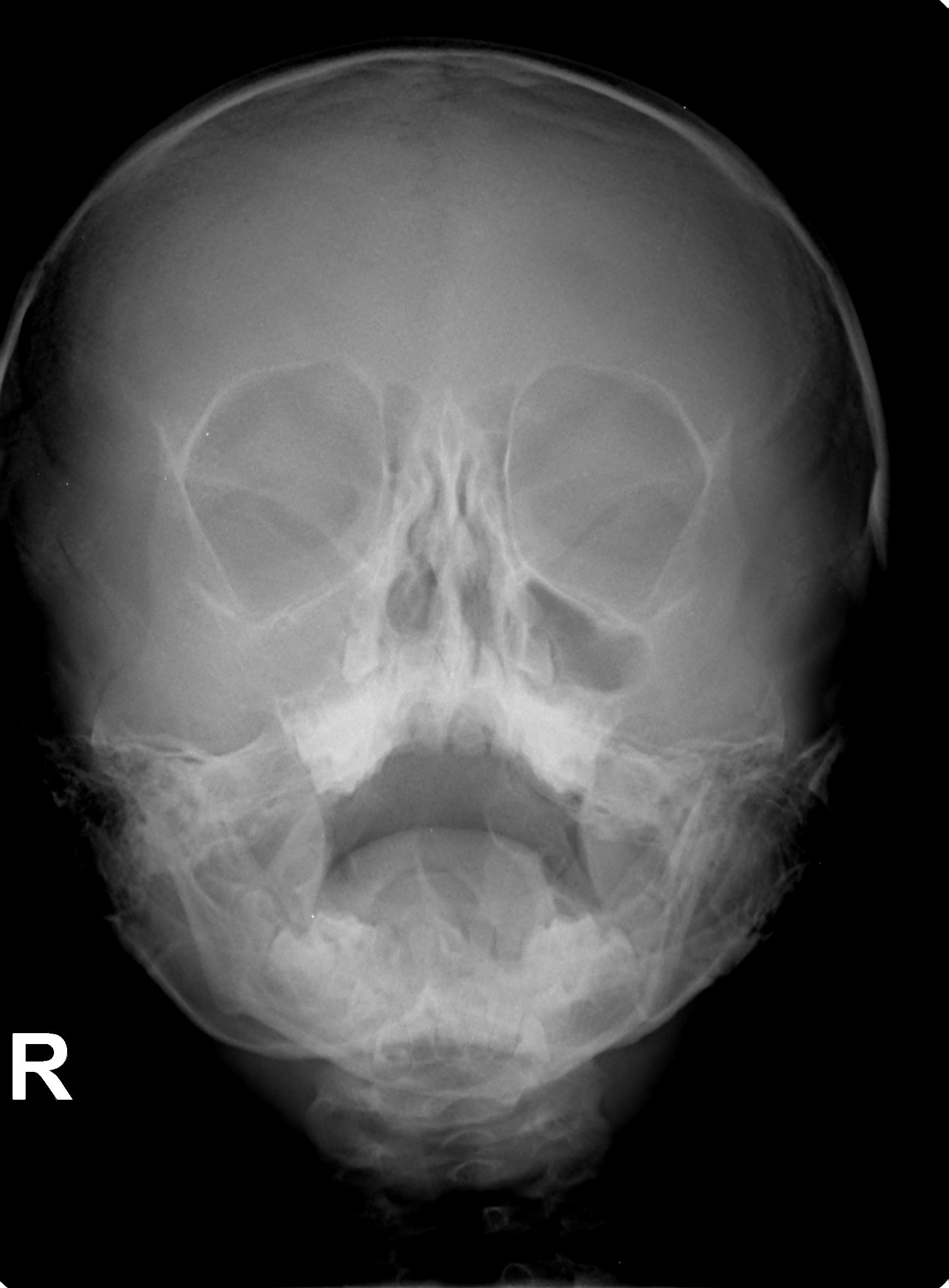 Преди проведено лечение / IS01_001.jpg IS01_001.jpg