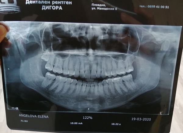рентгенова снимка на зъбите.jpg