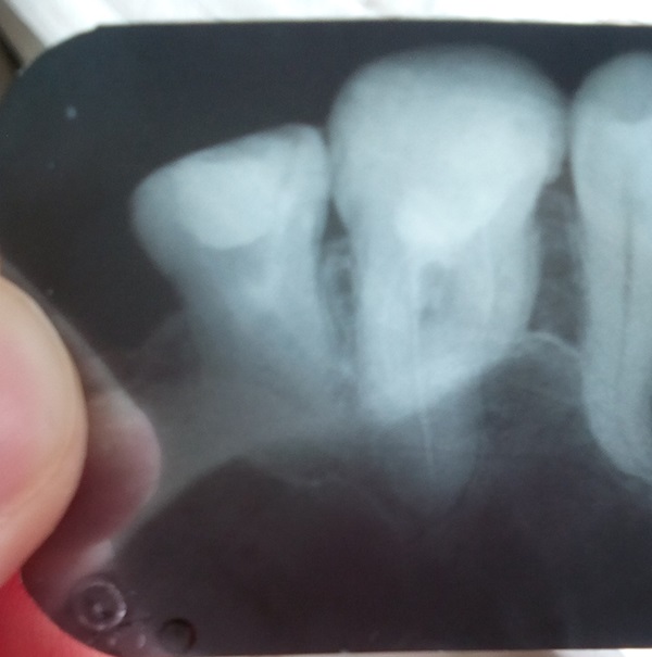 рентгенова зъбна снимка.jpg