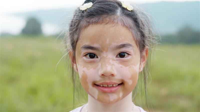 Vitiligo - kid.jpg